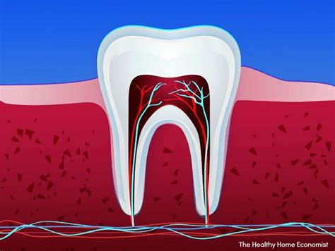 natural way to reverse a root chanel|How to Save a Damaged Tooth With No Root Canal .